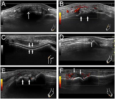 Imaging comparative analysis of familial and sporadic gout in Chinese men by multijoint ultrasonography